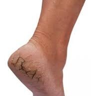 What Causes Cracked Feet and How to Treat Cracked Feet | How to Treat Cracked Feet