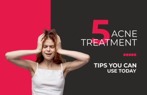 5 Acne Treatment Tips You Can Use Today