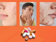 A Basic Guide on Medications for Acne