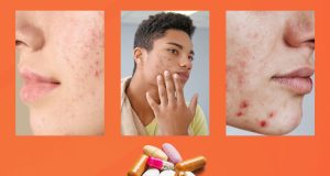 A Basic Guide on Medications for Acne