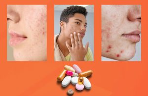A Basic Guide on Medications for Acne