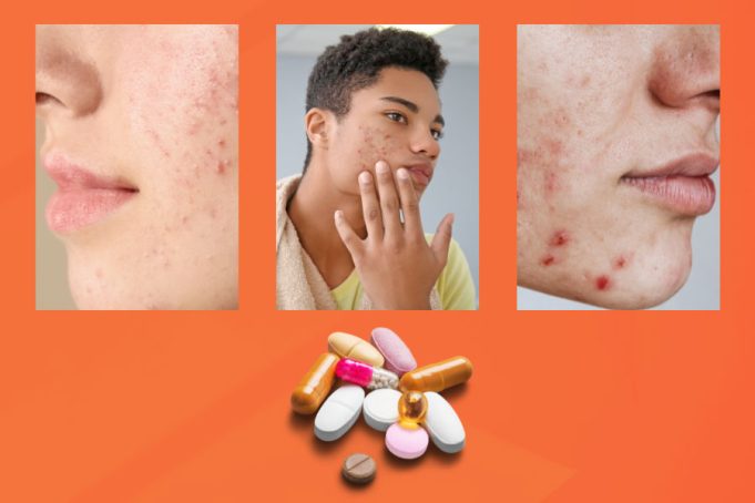 A Basic Guide on Medications for Acne