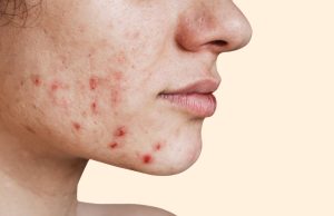 7 Little Known Acne Skin Care Secrets