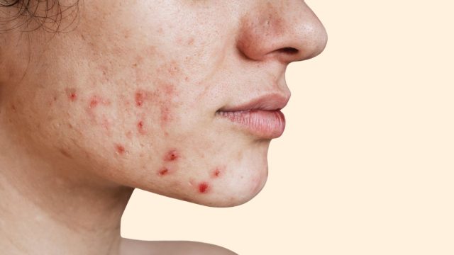 acne-face-map-alt-1440x810 (1)