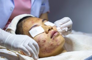 5 Tips Which Will Guarantee You Get the Best From Your Doctor in Relation to Your Acne Treatment