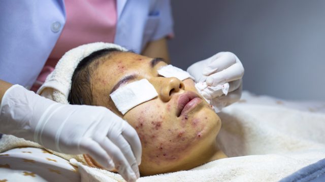 acne_treatment_at_dematologist_1488715930