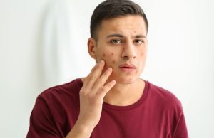 5 Things You Should Know About Acne Treatment Product