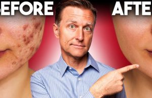 5 Tips For Getting Rid of Acne