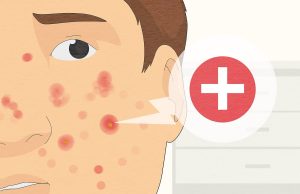 5 Easy Tips For Treating Acne
