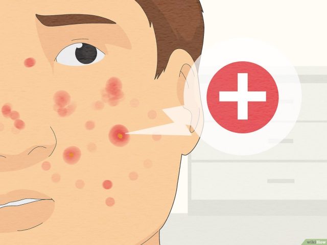 v4-1200px-Get-Rid-of-a-Pimple-Step-13-Version-4