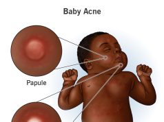 A Brief Overview Of Baby Acne
