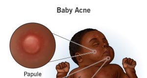 A Brief Overview Of Baby Acne