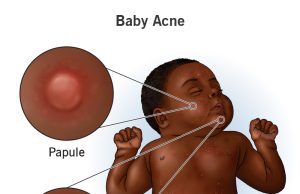 A Brief Overview Of Baby Acne