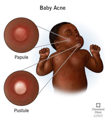 A Brief Overview Of Baby Acne