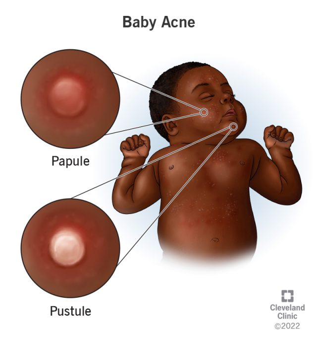A Brief Overview Of Baby Acne