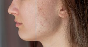 A Permanent Cure for Acne Scars ?