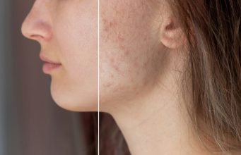 A Permanent Cure for Acne Scars ?