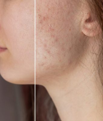 A Permanent Cure for Acne Scars ?
