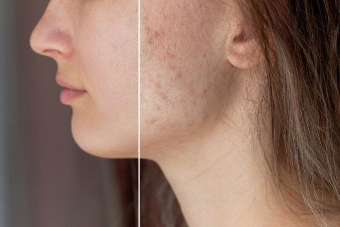 A Permanent Cure for Acne Scars ?